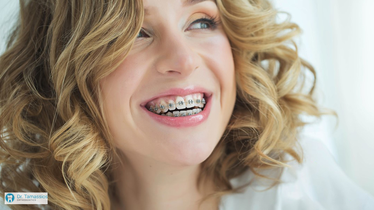 clear braces tseri